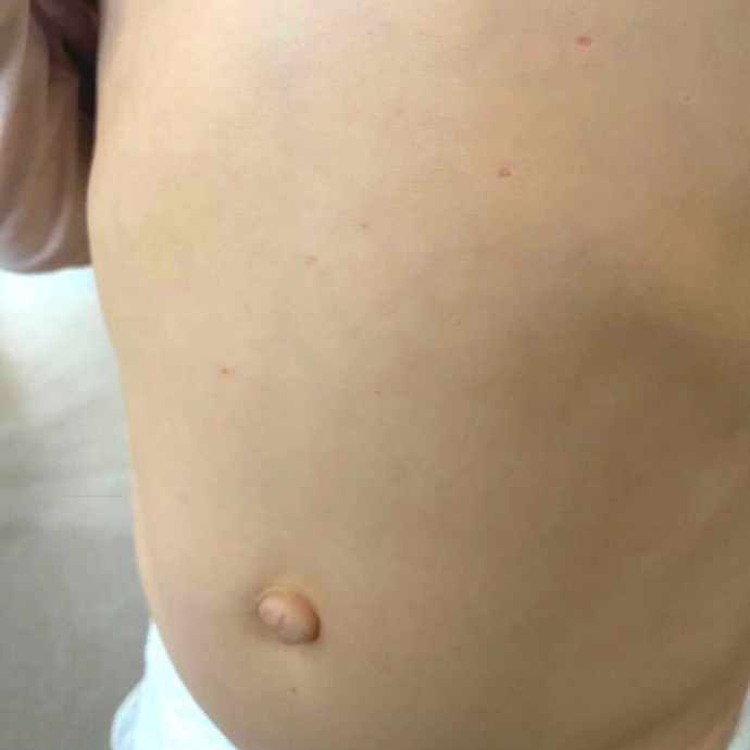 Molluscum Scarring-  Molluscum Support Group post